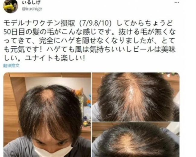 新冠会不会造成永久性脱发？_扎心了!感染新冠,还会脱发?