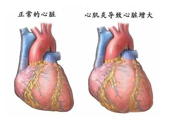病毒性心肌炎是什么病_什么是病毒性心肌炎