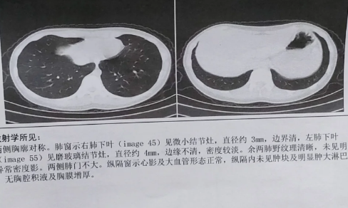 什么情况需要做肺部CT_肺部