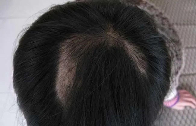 斑秃吃什么药快速治疗_斑秃吃什么药治疗好