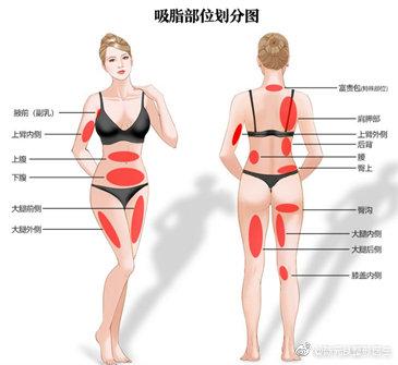 抽脂肪20斤一般多少钱（吸脂痛吗？价格大概多少？）