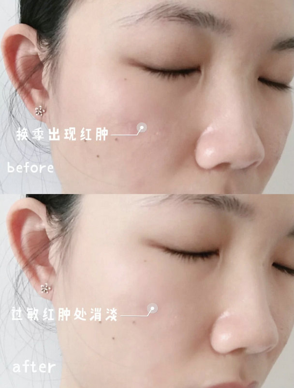 雅漾喷雾有消炎作用吗？ 真人实测舒泉调理喷雾的效果